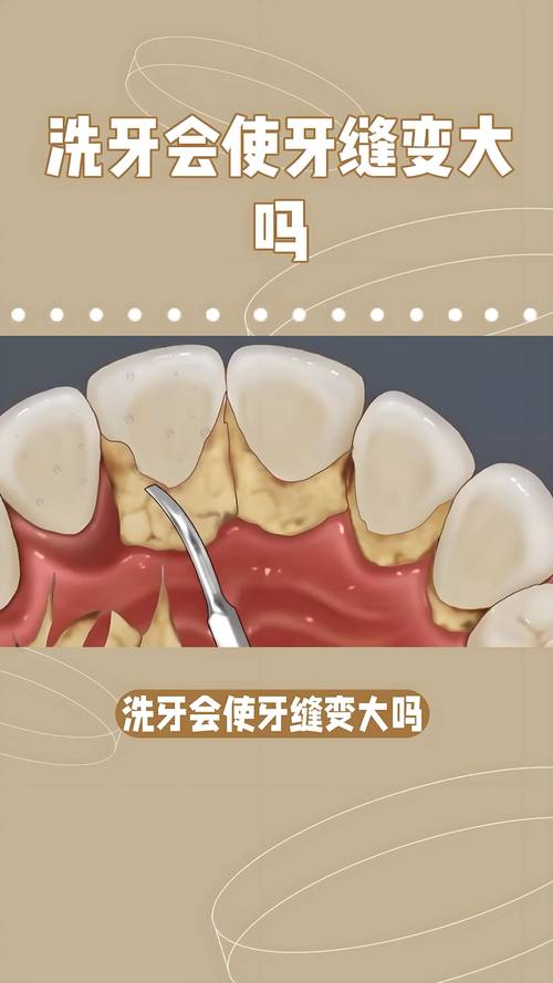 洗牙视频全过程2026