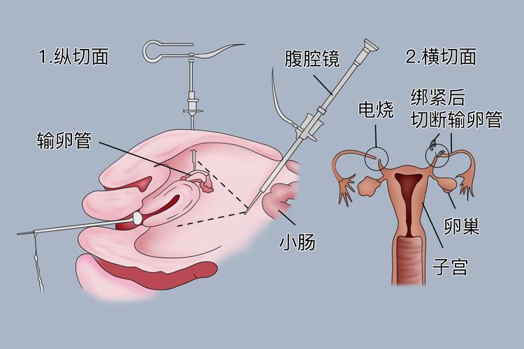 女性输卵管结扎手术视频2026