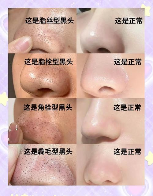 去黑头粉刺视频2026