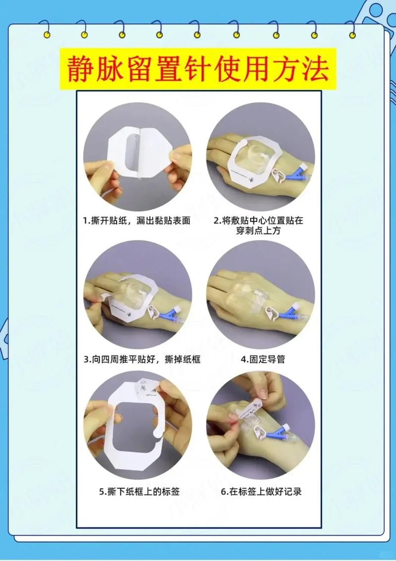 留置针操作视频2026