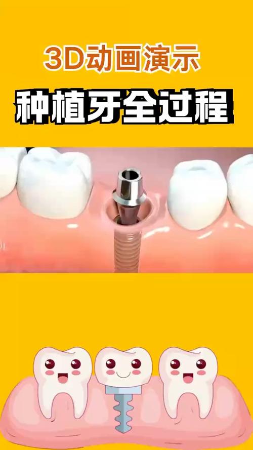 种植牙视频2026